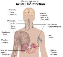 https://upload.wikimedia.org/wikipedia/commons/thumb/1/1b/symptoms_of_acute_hiv_infection.svg/220px-symptoms_of_acute_hiv_infection.svg.png