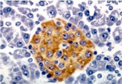 fig. 2: sección de páncreas normal con islote de langerhans con células positivas a anticuerpos contra insulina. 100 x.