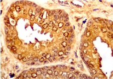 fig 1: sección de próstata normal con epitelio de los acinis positivo para anticuerpos contra antígeno prostático específico. 100 x.