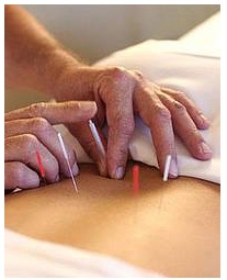 acupunctura.jpg