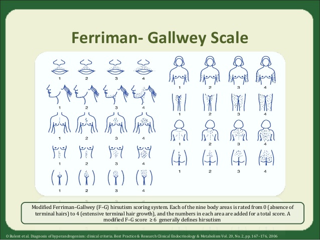 ferriman- gallwey scale modified ferriman–gallwey (f–g) hirsutism scoring system. each of the nine body areas is rated fr...