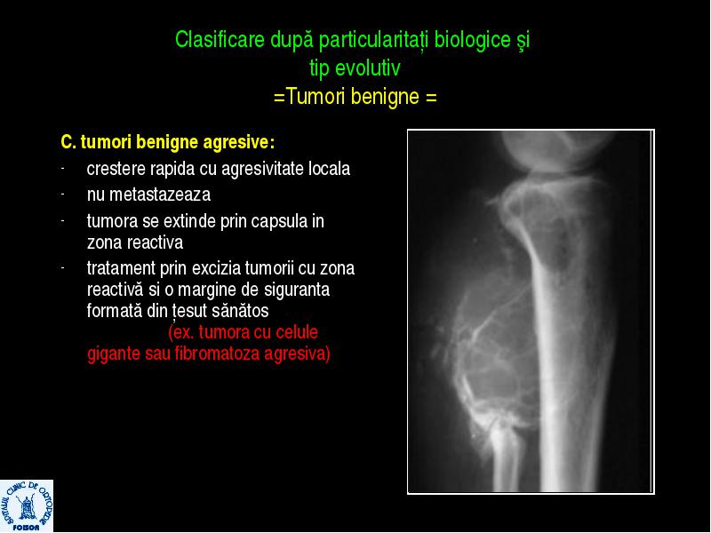 Tumorile Osoase Generalitati Tumori Benigne Prof. Univ. Dr. Mihai V ...